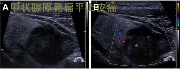 甲状腺原発扁平上皮癌 甲状腺原発扁平上皮癌