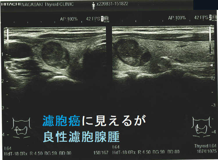 よし様 エコー 超音波(エコー)検査での腺腫様甲状腺腫・腺腫様結節と甲状腺乳頭