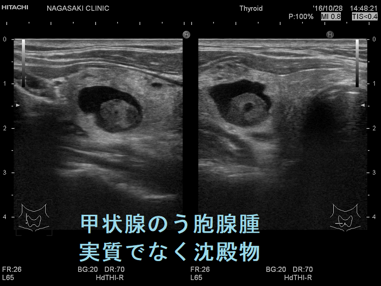 甲状腺のう胞腺腫 実質でなく沈殿物 超音波(エコー)画像 甲状腺のう胞腺腫 実質でなく沈殿物 超音波(エコー)画像