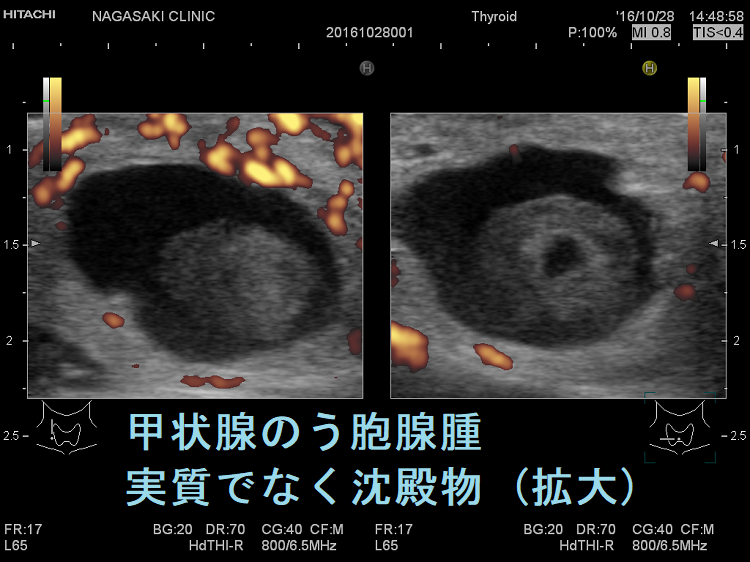 甲状腺のう胞腺腫 実質でなく沈殿物 超音波(エコー)画像(拡大) ドプラーモード 甲状腺のう胞腺腫 実質でなく沈殿物 超音波(エコー)画像(拡大) ドプラーモード