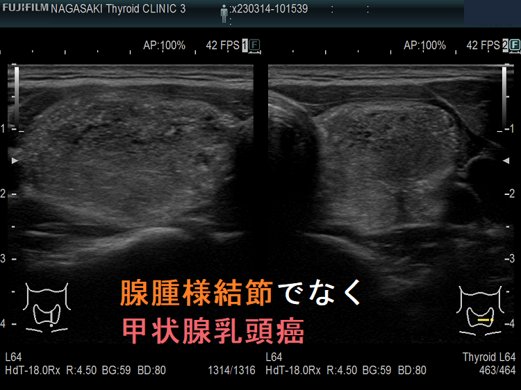 腺腫様結節でなく甲状腺乳頭癌 腺腫様結節でなく甲状腺乳頭癌