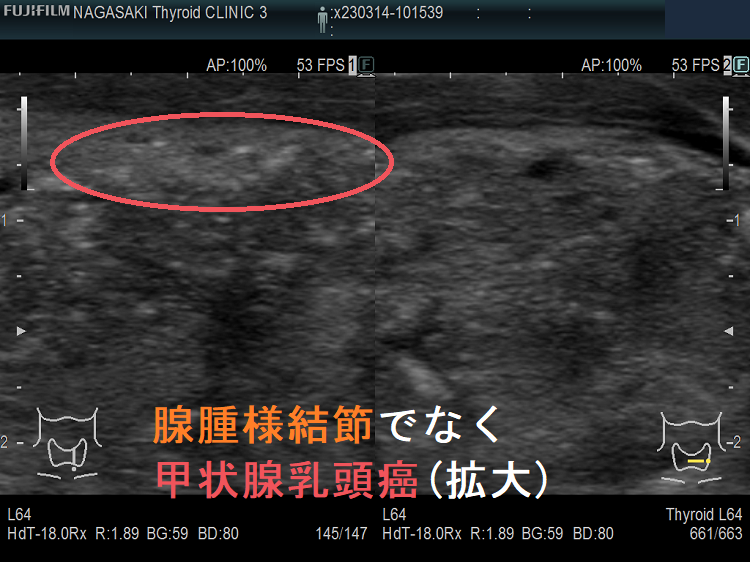 腺腫様結節でなく甲状腺乳頭癌(拡大) 腺腫様結節でなく甲状腺乳頭癌(拡大)
