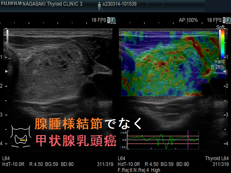 腺腫様結節でなく甲状腺乳頭癌 エラストグラフィー 腺腫様結節でなく甲状腺乳頭癌 エラストグラフィー