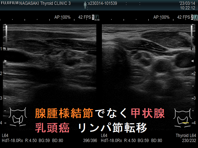 腺腫様結節でなく甲状腺乳頭癌 リンパ節転移 腺腫様結節でなく甲状腺乳頭癌 リンパ節転移