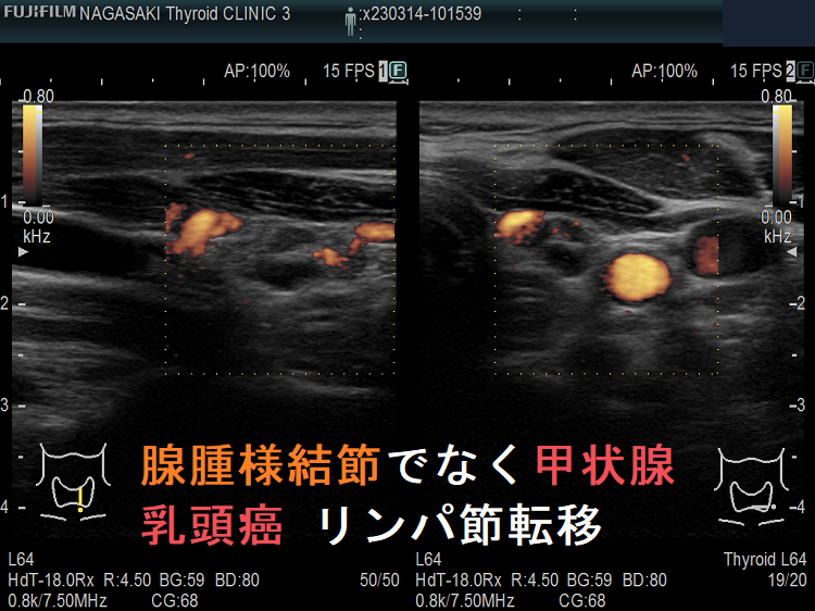 腺腫様結節でなく甲状腺乳頭癌 リンパ節転移 ドプラーモード 腺腫様結節でなく甲状腺乳頭癌 リンパ節転移 ドプラーモード