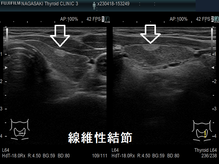 甲状腺線維性結節 超音波(エコー)画像 甲状腺線維性結節 超音波(エコー)画像