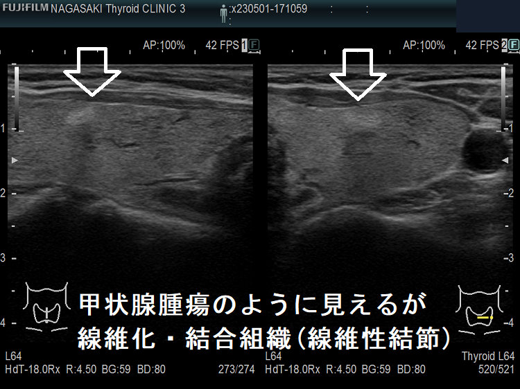 甲状腺腫瘍のように見えるが線維化・結合組織(線維性結節) 甲状腺腫瘍のように見えるが線維化・結合組織(線維性結節)
