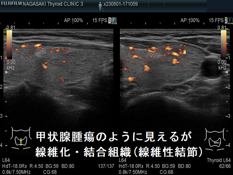 甲状腺腫瘍のように見えるが線維化・結合組織(線維性結節) ドプラーモード 甲状腺腫瘍のように見えるが線維化・結合組織(線維性結節) ドプラーモード