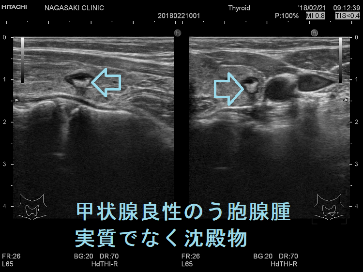 甲状腺良性のう胞腺腫 実質でなく沈殿物 甲状腺良性のう胞腺腫 実質でなく沈殿物