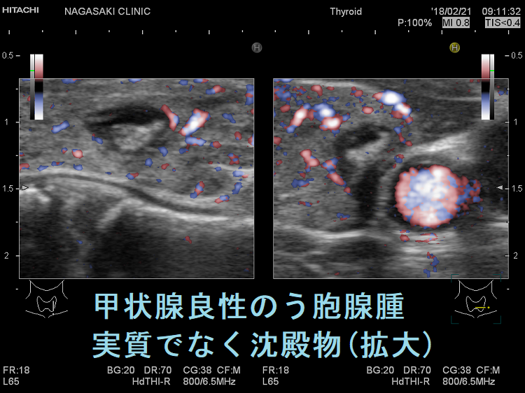 甲状腺良性のう胞腺腫 実質でなく沈殿物(拡大) 甲状腺良性のう胞腺腫 実質でなく沈殿物(拡大)