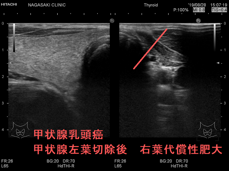 甲状腺乳頭癌 甲状腺左葉切除後 右葉代償性肥大 甲状腺乳頭癌 甲状腺左葉切除後 右葉代償性肥大