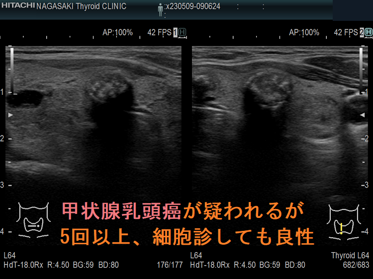 甲状腺乳頭癌が疑われるが5回以上細胞診しても良性 甲状腺乳頭癌が疑われるが5回以上細胞診しても良性