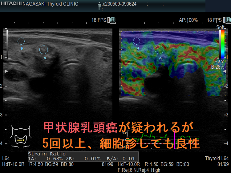 甲状腺乳頭癌が疑われるが5回以上細胞診しても良性 エラストグラフィー 甲状腺乳頭癌が疑われるが5回以上細胞診しても良性 エラストグラフィー