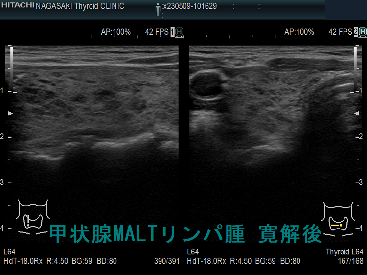 甲状腺MALTリンパ腫 寛解後 超音波(エコー)画像 右 甲状腺MALTリンパ腫 寛解後 超音波(エコー)画像 右