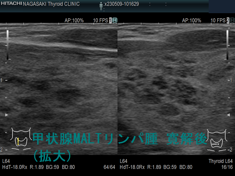 甲状腺MALTリンパ腫 寛解後 超音波(エコー)画像 (拡大) 右 甲状腺MALTリンパ腫 寛解後 超音波(エコー)画像 (拡大) 右