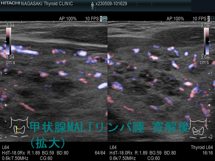 甲状腺MALTリンパ腫 寛解後 超音波(エコー)画像 (拡大) ドプラーモード 右 甲状腺MALTリンパ腫 寛解後 超音波(エコー)画像 (拡大) ドプラーモード 右