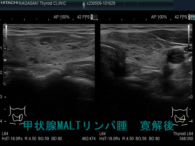 甲状腺MALTリンパ腫 寛解後 超音波(エコー)画像 左 甲状腺MALTリンパ腫 寛解後 超音波(エコー)画像 左