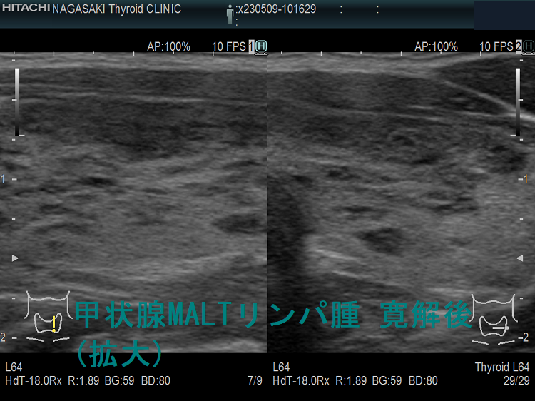 甲状腺MALTリンパ腫 寛解後 超音波(エコー)画像 (拡大) 左 甲状腺MALTリンパ腫 寛解後 超音波(エコー)画像 (拡大) 左