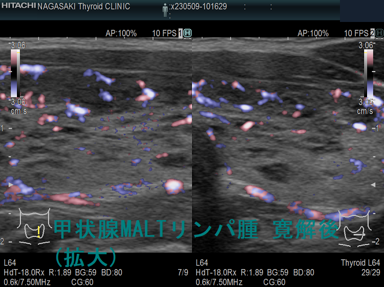 甲状腺MALTリンパ腫 寛解後 超音波(エコー)画像 (拡大) ドプラーモード 左 甲状腺MALTリンパ腫 寛解後 超音波(エコー)画像 (拡大) ドプラーモード 左
