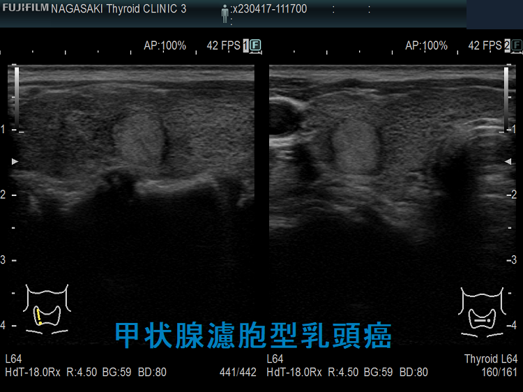 甲状腺濾胞型乳頭癌(FVPTC) 甲状腺濾胞型乳頭癌(FVPTC)
