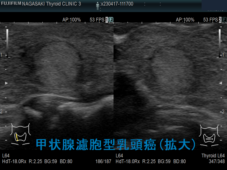 甲状腺濾胞型乳頭癌(FVPTC)(拡大) 甲状腺濾胞型乳頭癌(FVPTC)(拡大)