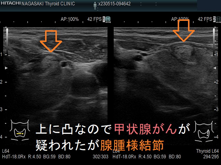 超音波(エコー)検査での腺腫様甲状腺腫・腺腫様結節と甲状腺乳頭 超音波(エコー)検査での腺腫様甲状腺腫・腺腫様結節と甲状腺乳頭