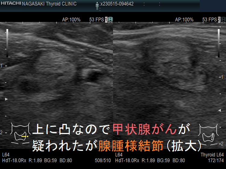 上に凸なので甲状腺がんが疑われたが腺腫様結節(拡大) 上に凸なので甲状腺がんが疑われたが腺腫様結節(拡大)