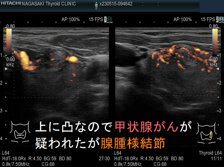 上に凸なので甲状腺がんが疑われたが腺腫様結節 ドプラーモード 上に凸なので甲状腺がんが疑われたが腺腫様結節 ドプラーモード