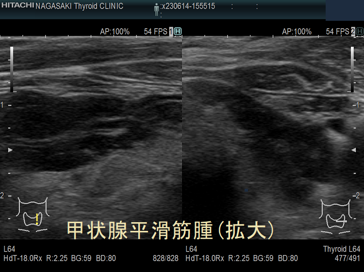 甲状腺平滑筋腫 超音波(エコー)画像(拡大) 甲状腺平滑筋腫 超音波(エコー)画像(拡大)