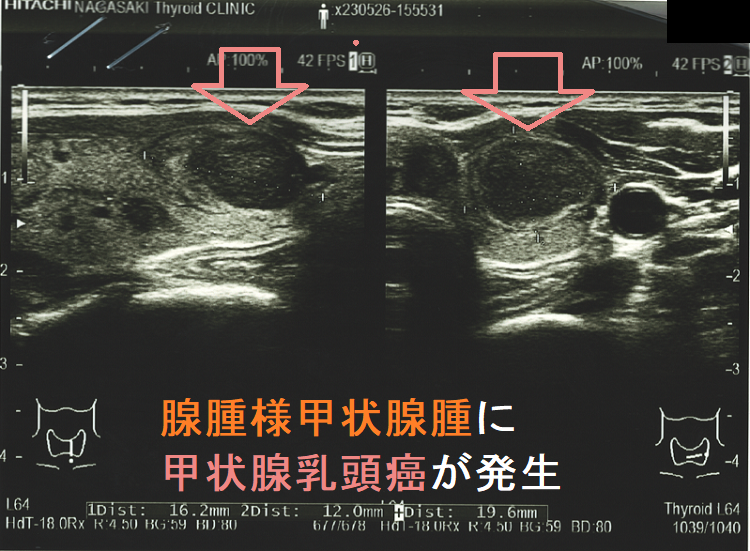 腺腫様甲状腺腫・腺腫様結節[橋本病 バセドウ病 甲状腺超音波 腺腫様甲状腺腫・腺腫様結節[橋本病 バセドウ病 甲状腺超音波