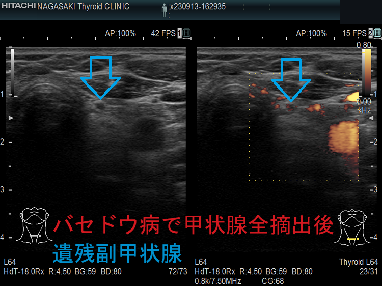バセドウ病で甲状腺全摘出後 遺残副甲状腺 超音波(エコー)画像 バセドウ病で甲状腺全摘出後 遺残副甲状腺 超音波(エコー)画像