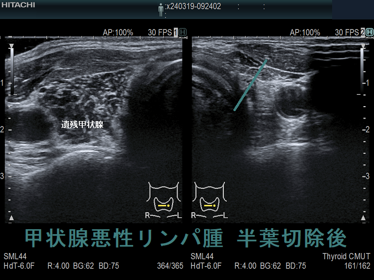 甲状腺悪性リンパ腫 半葉切除後 超音波(エコー)画像 甲状腺悪性リンパ腫 半葉切除後 超音波(エコー)画像