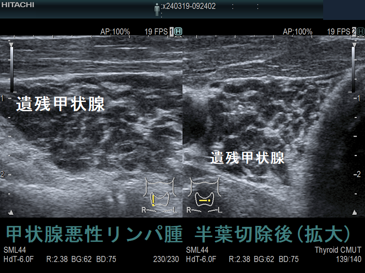甲状腺悪性リンパ腫 半葉切除後(垂直断・水平断) 甲状腺悪性リンパ腫 半葉切除後(垂直断・水平断)