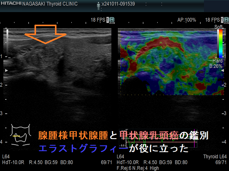 腺腫様甲状腺腫と甲状腺乳頭癌の鑑別 エラストグラフィーが役に立った4 腺腫様甲状腺腫と甲状腺乳頭癌の鑑別 エラストグラフィーが役に立った4