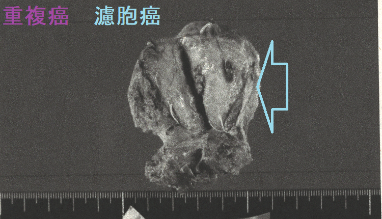 甲状腺濾胞癌と甲状腺微小乳頭癌の重複癌 手術摘出標本(甲状腺濾胞癌)2 甲状腺濾胞癌と甲状腺微小乳頭癌の重複癌 手術摘出標本(甲状腺濾胞癌)2