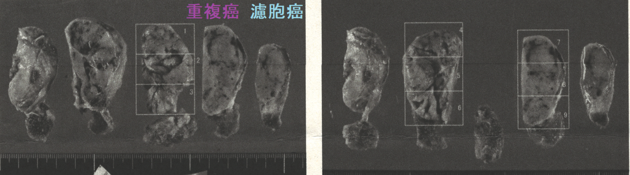 甲状腺濾胞癌と甲状腺微小乳頭癌の重複癌 手術摘出標本(甲状腺濾胞癌) 甲状腺濾胞癌と甲状腺微小乳頭癌の重複癌 手術摘出標本(甲状腺濾胞癌)