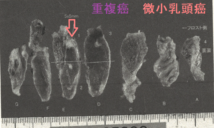 甲状腺濾胞癌と甲状腺微小乳頭癌の重複癌 手術摘出標本(甲状腺微小乳頭癌) 甲状腺濾胞癌と甲状腺微小乳頭癌の重複癌 手術摘出標本(甲状腺微小乳頭癌)