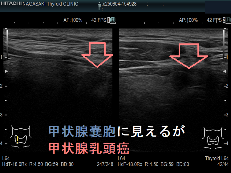 甲状腺嚢胞に見えるが甲状腺乳頭癌 甲状腺嚢胞に見えるが甲状腺乳頭癌1