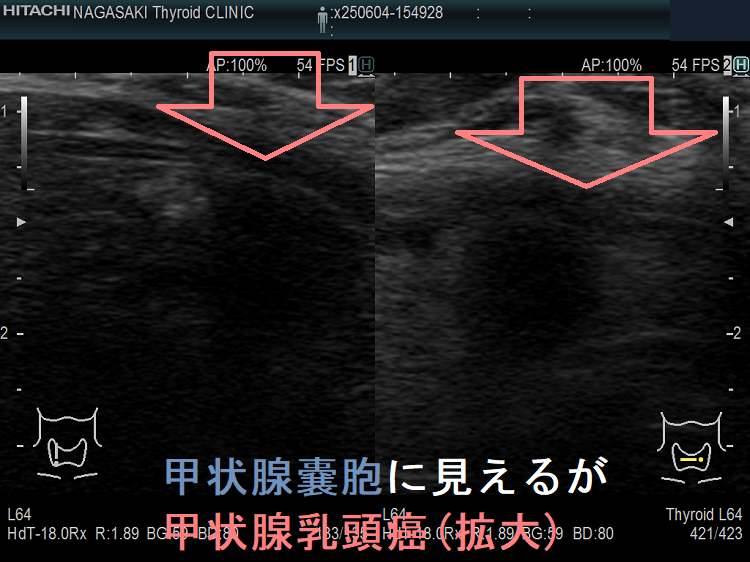 甲状腺嚢胞に見えるが甲状腺乳頭癌(拡大) 甲状腺嚢胞に見えるが甲状腺乳頭癌(拡大)