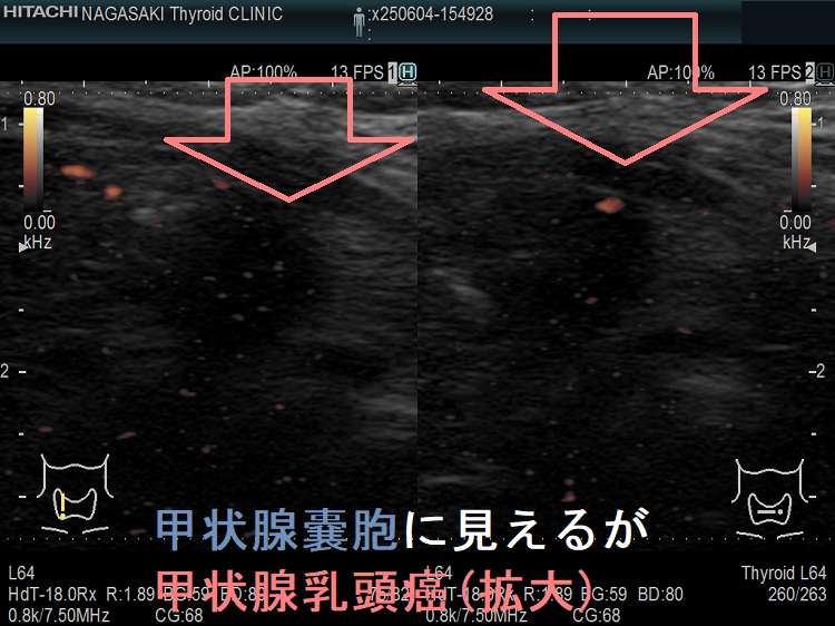 甲状腺嚢胞に見えるが甲状腺乳頭癌(拡大)ドプラーモード 甲状腺嚢胞に見えるが甲状腺乳頭癌(拡大)ドプラーモード