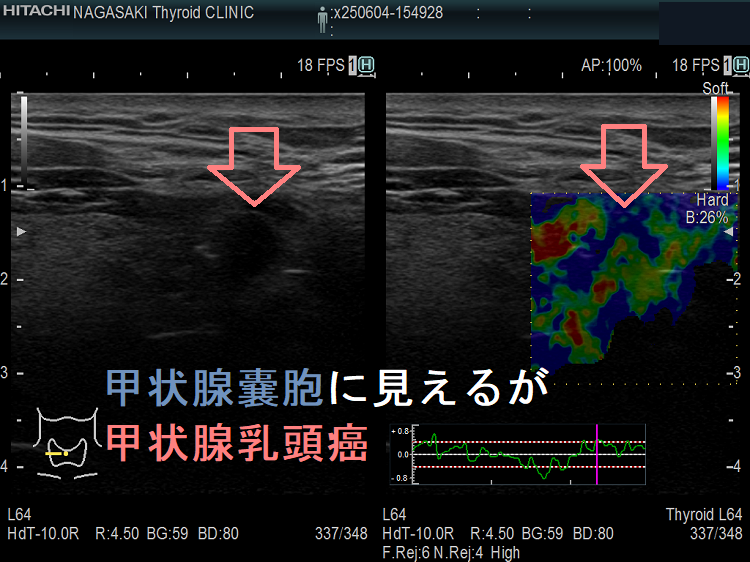 甲状腺嚢胞に見えるが甲状腺乳頭癌 エラストグラフィー 甲状腺嚢胞に見えるが甲状腺乳頭癌 エラストグラフィー