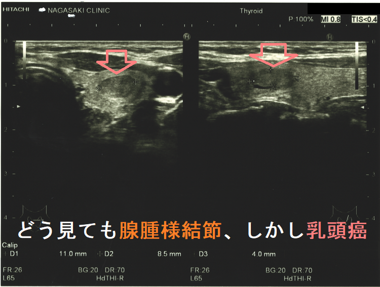 どう見ても腺腫様結節、しかし甲状腺乳頭癌 超音波(エコー)画像 どう見ても腺腫様結節、しかし甲状腺乳頭癌 超音波(エコー)画像