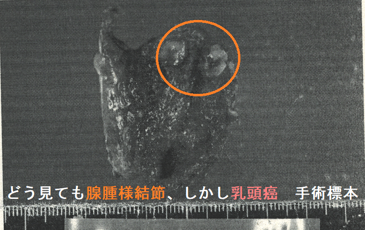 どう見ても腺腫様結節、しかし甲状腺乳頭癌 手術標本 どう見ても腺腫様結節、しかし甲状腺乳頭癌 手術標本