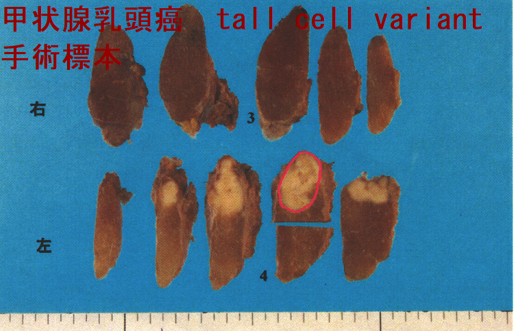 高悪性度(高増殖型,高MIB-1標識率)甲状腺乳頭癌高細胞型