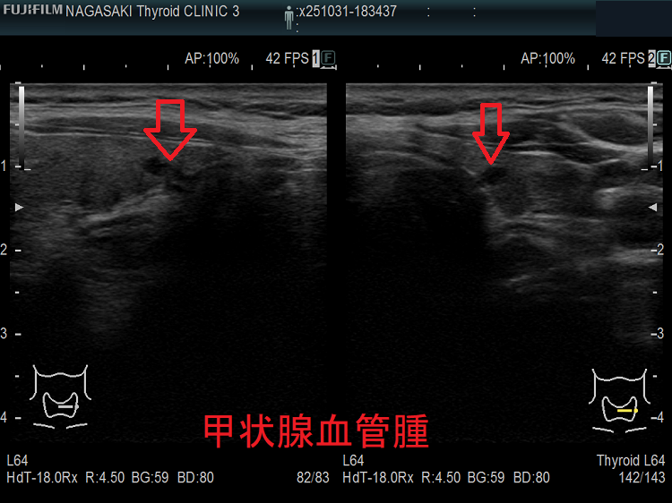 甲状腺血管腫 甲状腺血管腫