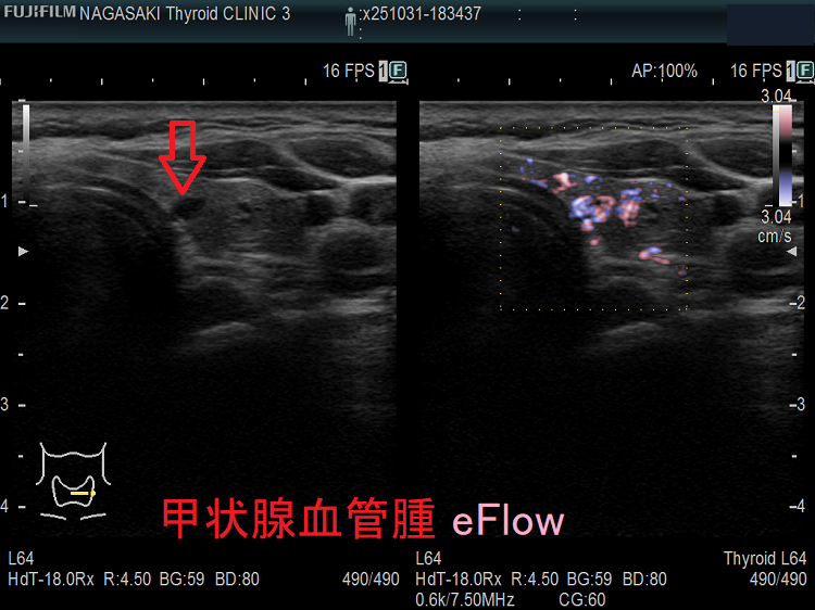 甲状腺血管腫 eFlow 甲状腺血管腫 eFlow