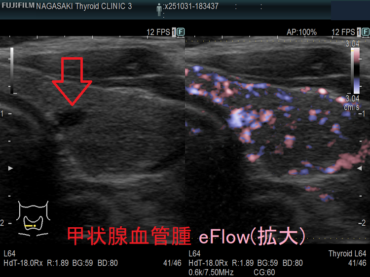 甲状腺血管腫 eFlow(拡大) 甲状腺血管腫 eFlow(拡大)