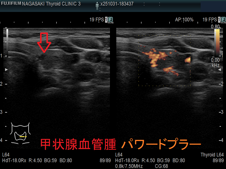 甲状腺血管腫 パワードプラー 甲状腺血管腫 パワードプラー