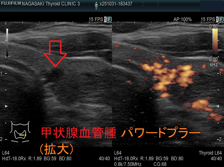 甲状腺血管腫 パワードプラー(拡大) 甲状腺血管腫 パワードプラー(拡大)