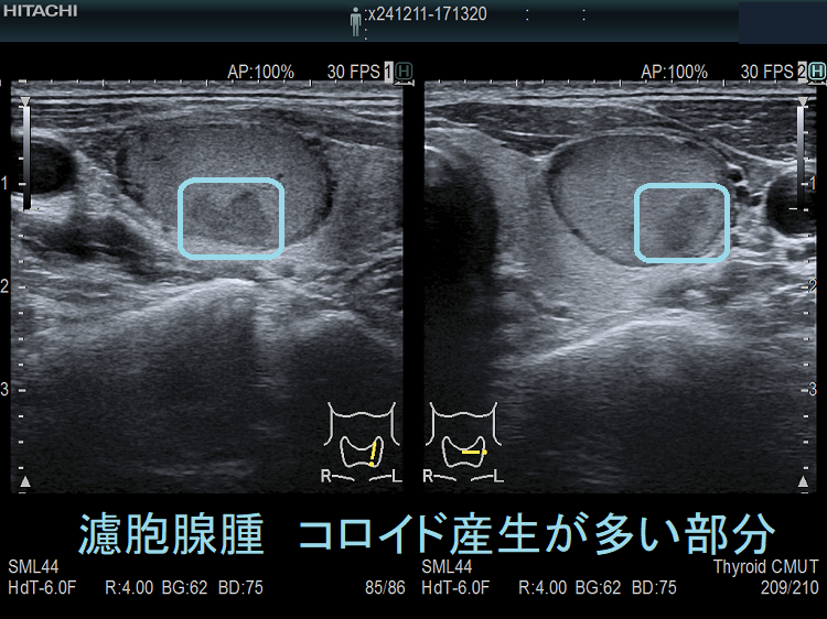 濾胞腺腫 コロイド産生が多い部分 濾胞腺腫 コロイド産生が多い部分